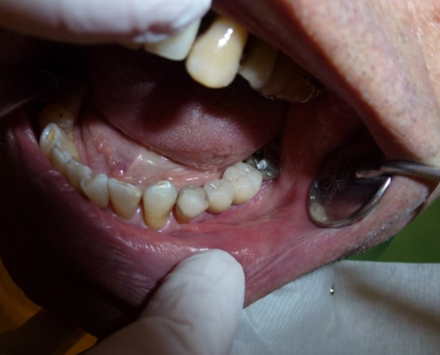 Krankenkasse Amalgam-Füllungen