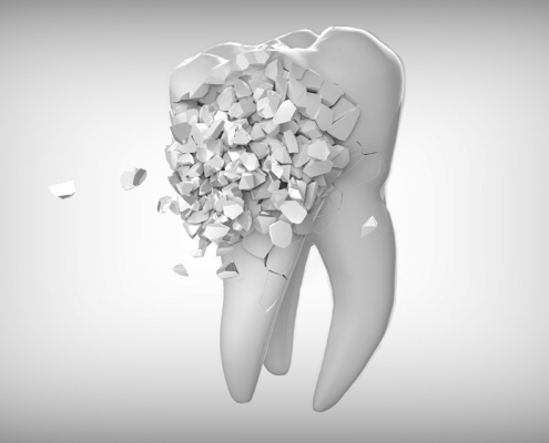 Zahnversiegelung Amalgamfüllung