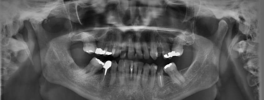Zahnfüllung 6 Schritt-Pflegeprogramm von Zahnfüllungen